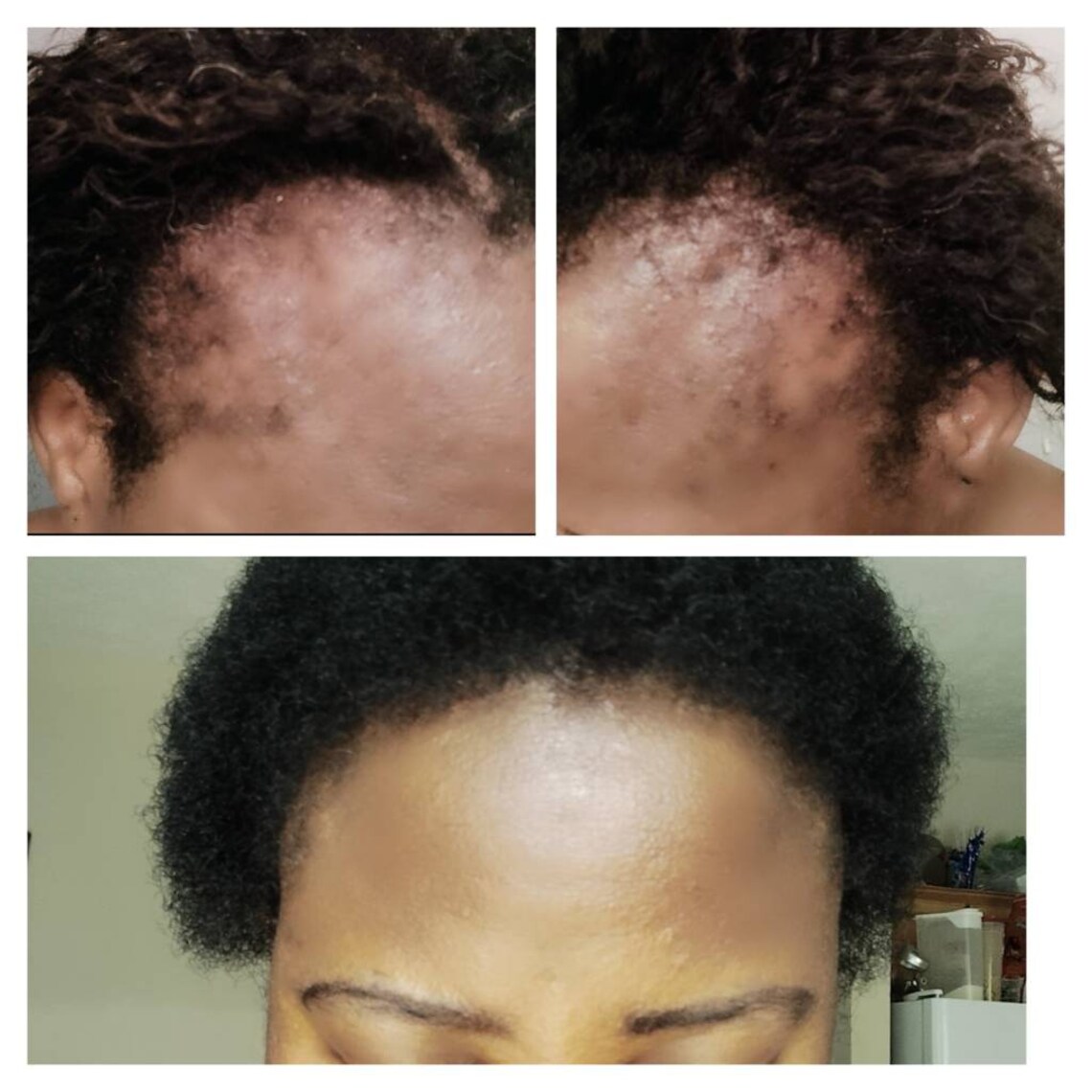 Cloves Supergrowth Hair Spray to Reverse Traction Alopecia and Severe