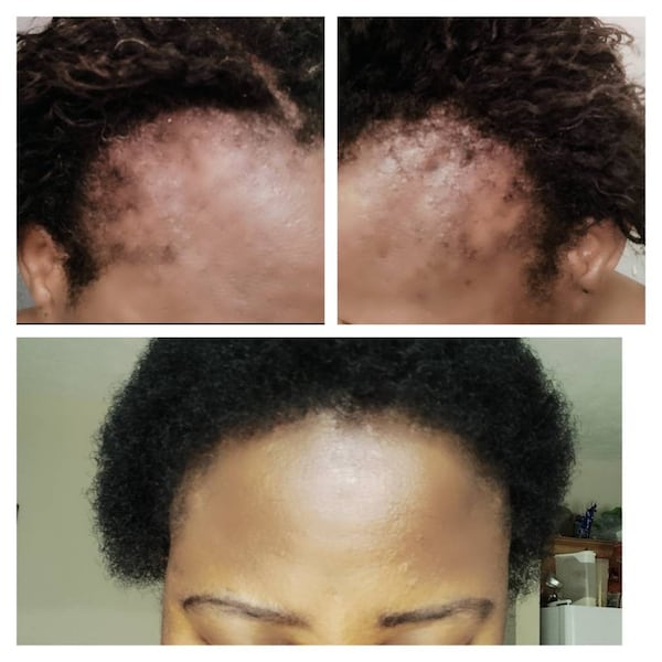 Cloves Super-growth hair spray  to reverse traction alopecia and severe hair damage (STEP 1)