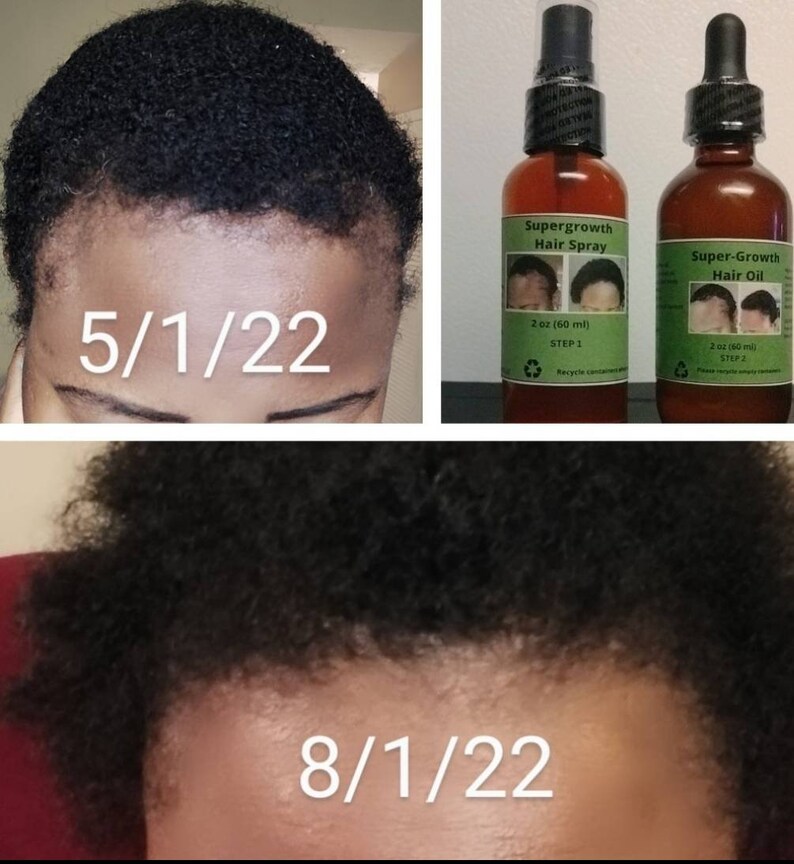 Cloves Supergrowth Hair Spray to Reverse Traction Alopecia Etsy