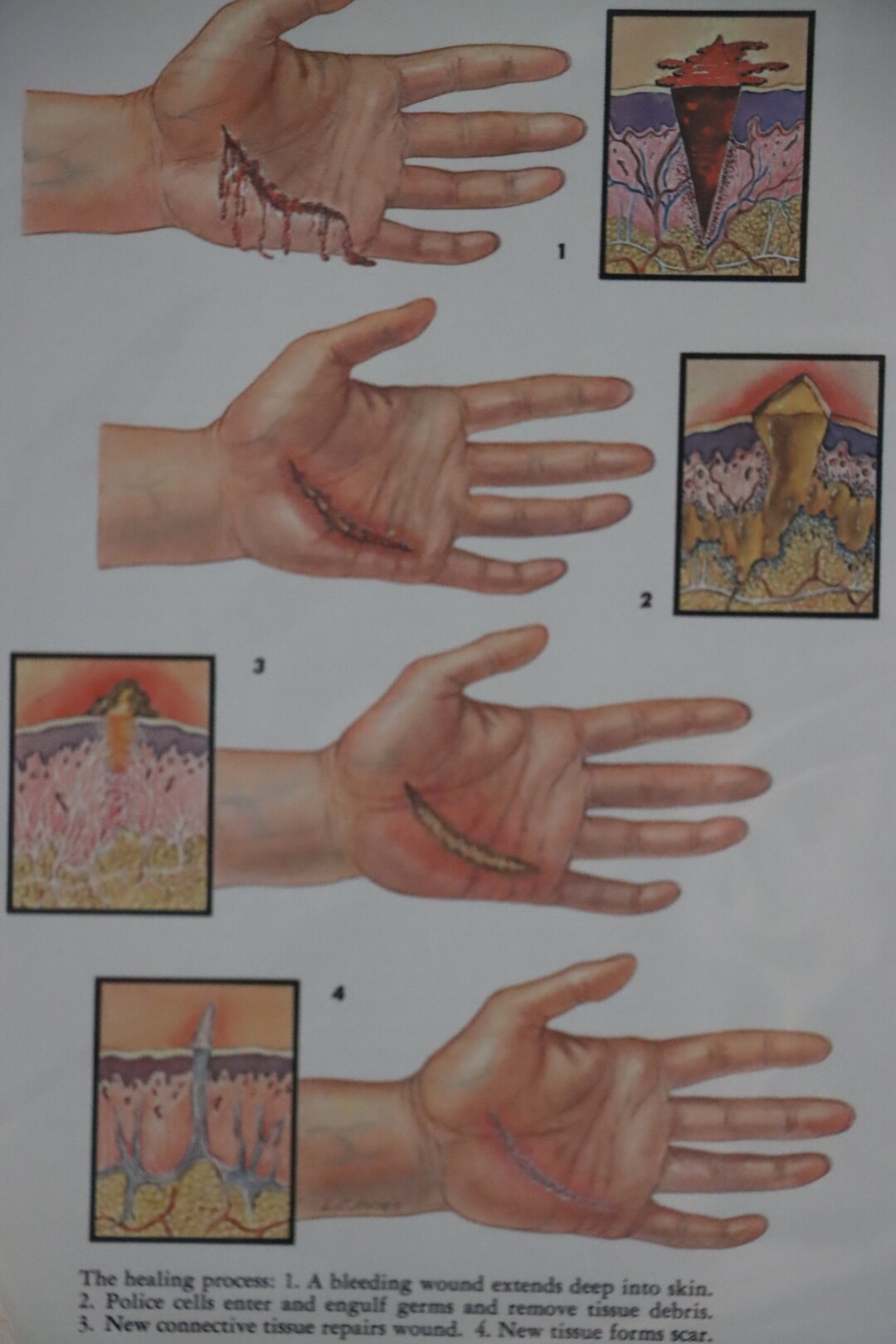 The Healing Process Skin Anatomy Wound Unit Study Homeschool Biology Diagrams