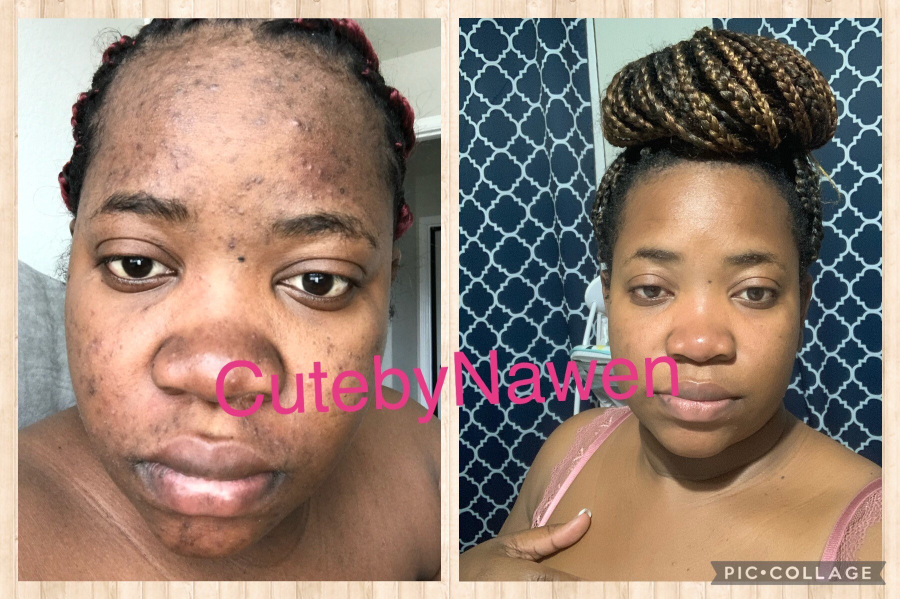 Acne Scar and Dark Spot Remover Etsy