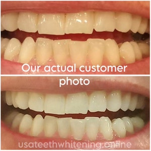 Pu&ograve; includere: Foto prima e dopo dei denti di una persona. La foto in alto mostra i denti della persona prima dello sbiancamento dentale. La foto in basso mostra i denti della persona dopo lo sbiancamento dentale. I denti sono pi&ugrave; bianchi e luminosi nella foto dopo. "La nostra foto reale di un cliente" &egrave; scritta al centro dell'immagine.