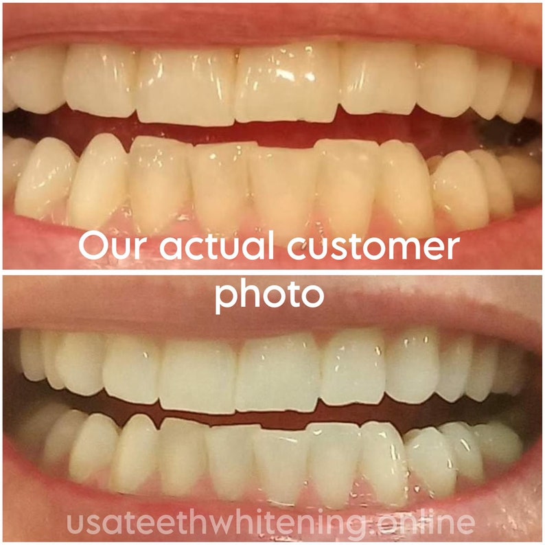 Pu&ograve; includere: Foto prima e dopo dei denti di una persona. La foto in alto mostra i denti della persona prima dello sbiancamento dentale. La foto in basso mostra i denti della persona dopo lo sbiancamento dentale. I denti sono pi&ugrave; bianchi e luminosi nella foto dopo. "La nostra foto reale di un cliente" &egrave; scritta al centro dell'immagine.