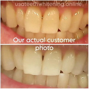 Pu&ograve; includere: Fotografie prima e dopo di un trattamento di sbiancamento dentale. La foto in alto mostra i denti prima dello sbiancamento, e la foto in basso mostra i denti dopo lo sbiancamento. I denti sono pi&ugrave; bianchi nella foto in basso.