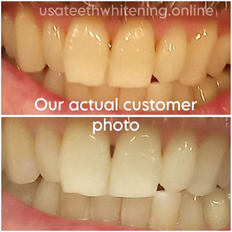 Pu&ograve; includere: Fotografie prima e dopo di un trattamento di sbiancamento dentale. La foto in alto mostra i denti prima dello sbiancamento, e la foto in basso mostra i denti dopo lo sbiancamento. I denti sono pi&ugrave; bianchi nella foto in basso.