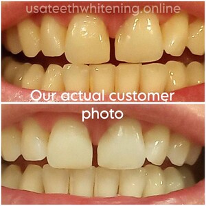 Pu&ograve; includere: Fotografie prima e dopo che mostrano i risultati dello sbiancamento dei denti. La foto in alto mostra denti gialli, e la foto in basso mostra denti pi&ugrave; bianchi.