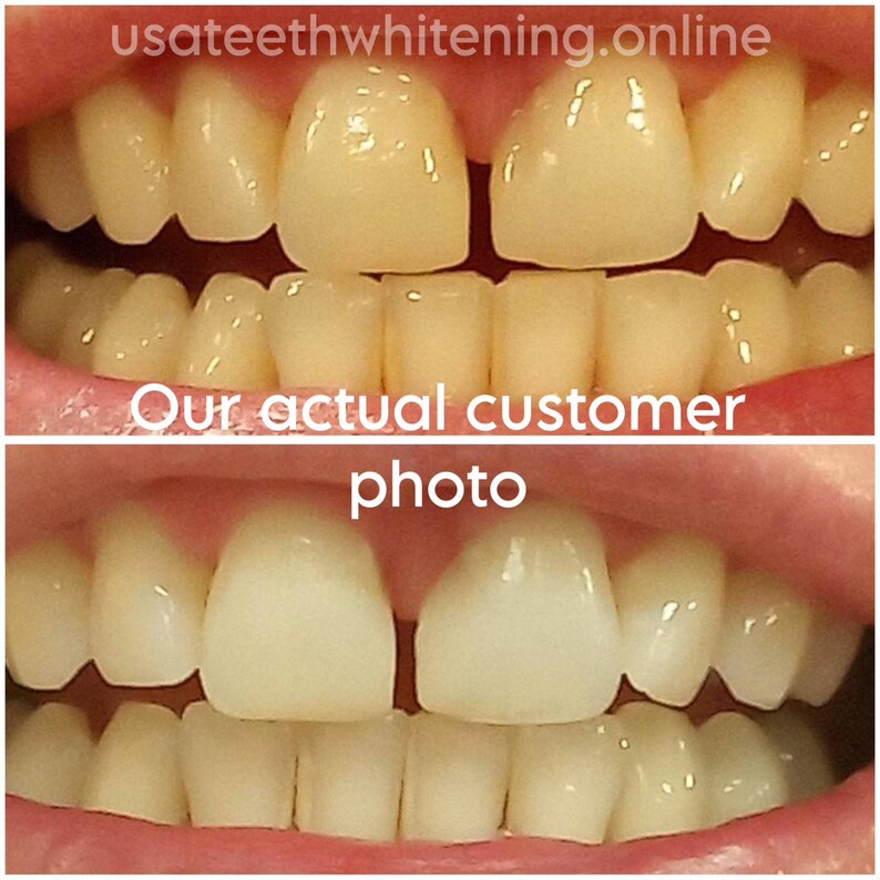 Pu&ograve; includere: Fotografie prima e dopo che mostrano i risultati dello sbiancamento dei denti. La foto in alto mostra denti gialli, e la foto in basso mostra denti pi&ugrave; bianchi.
