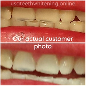 Pu&ograve; includere: Fotografie prima e dopo che mostrano i risultati dello sbiancamento dei denti. La foto in alto mostra denti ingialliti e macchiati. La foto in basso mostra denti pi&ugrave; bianchi e luminosi.