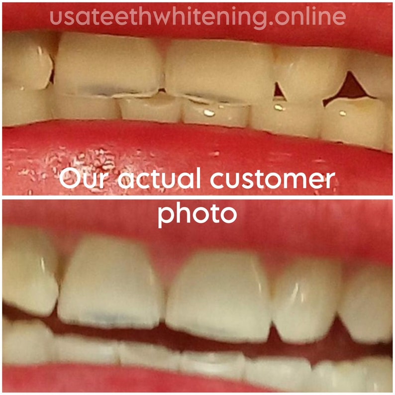 Pu&ograve; includere: Fotografie prima e dopo che mostrano i risultati dello sbiancamento dei denti. La foto in alto mostra denti ingialliti e macchiati. La foto in basso mostra denti pi&ugrave; bianchi e luminosi.