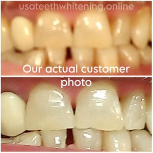Pu&ograve; includere: Fotografie prima e dopo che mostrano i risultati dello sbiancamento dei denti. La foto in alto mostra denti gialli. La foto in basso mostra denti pi&ugrave; bianchi.