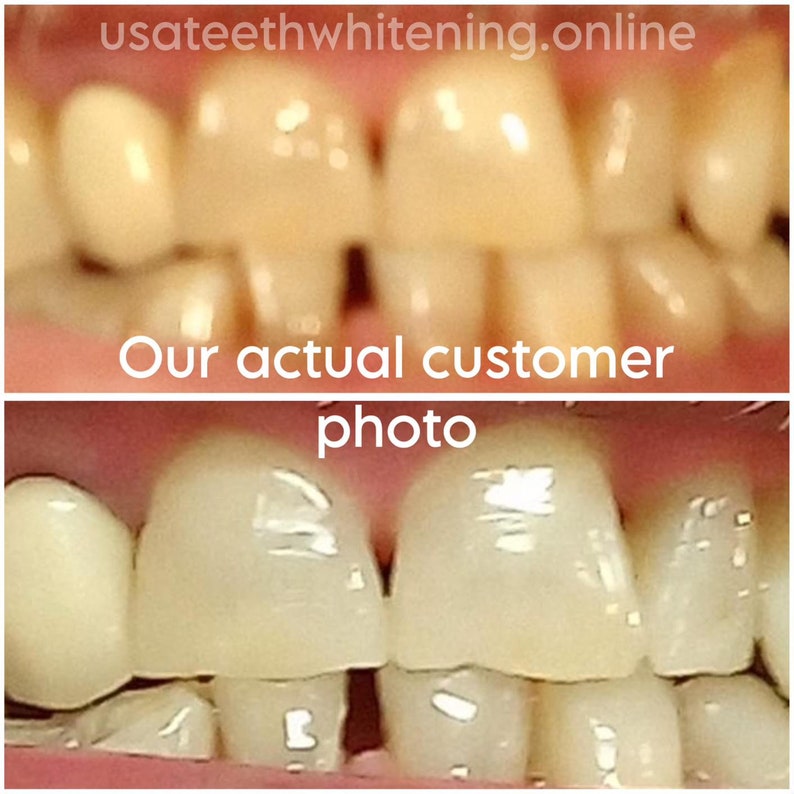 Pu&ograve; includere: Fotografie prima e dopo che mostrano i risultati dello sbiancamento dei denti. La foto in alto mostra denti gialli. La foto in basso mostra denti pi&ugrave; bianchi.