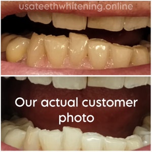 Pu&ograve; includere: Foto prima e dopo che mostrano i risultati dello sbiancamento dentale. La foto in alto mostra denti gialli, e la foto in basso mostra denti bianchi. Il testo "Our actual customer photo" &egrave; visibile nella foto in basso.