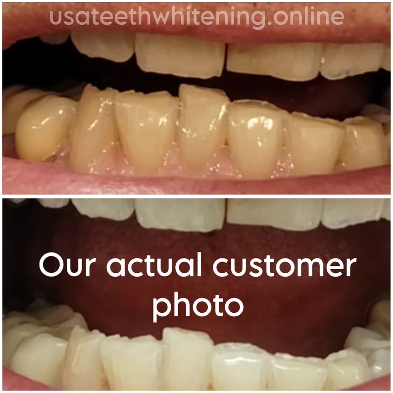 Pu&ograve; includere: Foto prima e dopo che mostrano i risultati dello sbiancamento dentale. La foto in alto mostra denti gialli, e la foto in basso mostra denti bianchi. Il testo "Our actual customer photo" &egrave; visibile nella foto in basso.