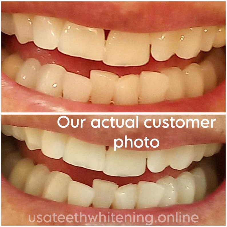 Pu&ograve; includere: Foto prima e dopo che mostrano i risultati dello sbiancamento dentale di una persona. La foto in alto mostra i denti della persona prima dello sbiancamento, e la foto in basso mostra i denti della persona dopo lo sbiancamento. I denti sono visibilmente pi&ugrave; bianchi nella foto dopo. Il testo "Our actual customer photo" &egrave; visualizzato sotto le foto. Il testo "usateethwhitening.online" &egrave; visualizzato sotto il testo.