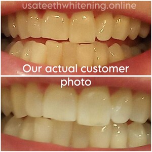 Pu&ograve; includere: Foto prima e dopo dei denti di una persona dopo aver utilizzato un prodotto sbiancante per denti. La foto in alto mostra i denti della persona prima dello sbiancamento, e la foto in basso mostra i denti della persona dopo lo sbiancamento. I denti sono visibilmente pi&ugrave; bianchi nella foto dopo. Il testo "La nostra foto reale del cliente" &egrave; visualizzato sotto le foto.