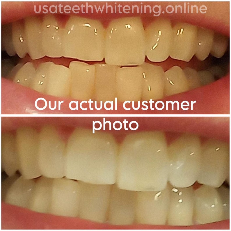Pu&ograve; includere: Foto prima e dopo dei denti di una persona dopo aver utilizzato un prodotto sbiancante per denti. La foto in alto mostra i denti della persona prima dello sbiancamento, e la foto in basso mostra i denti della persona dopo lo sbiancamento. I denti sono visibilmente pi&ugrave; bianchi nella foto dopo. Il testo "La nostra foto reale del cliente" &egrave; visualizzato sotto le foto.