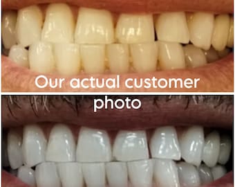 Teeth Whitening ALOT of Gel ! 2+ yr shelf life ZERO pain Tips Instructions Includ Made in USA 100% Safe & Effective Gluten Free Real Results