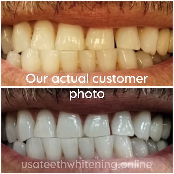 Teeth Whitening ALOT of Gel ! 2+ yr shelf life ZERO pain Tips Instructions Includ Made in USA 100% Safe & Effective Gluten Free Real Results