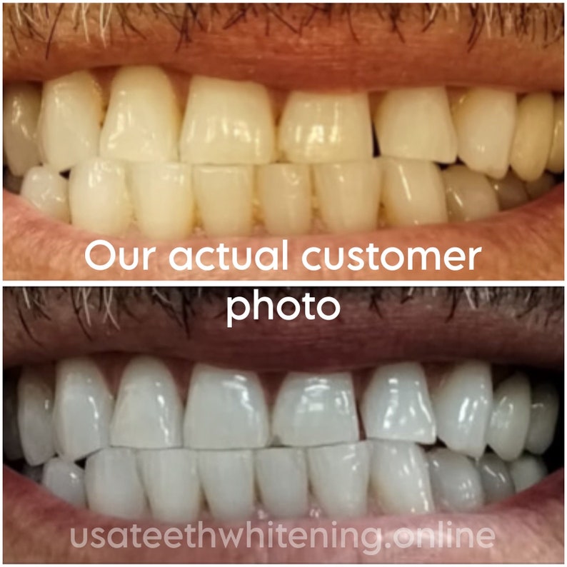 Pu&ograve; includere: Fotografie prima e dopo di un trattamento di sbiancamento dentale. La foto in alto mostra i denti della persona prima dello sbiancamento, e la foto in basso mostra i denti della persona dopo lo sbiancamento. I denti sono molto pi&ugrave; bianchi nella foto dopo. usateethwhitening.online