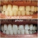 USA Teeth Whitening