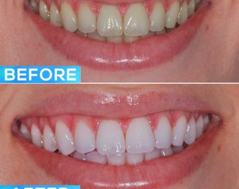 TEETH WHITENING COURSE