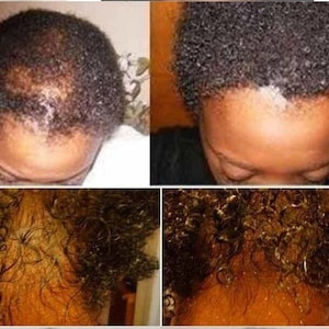 May include: Before and after photos showing hair growth on a person's scalp. The top left photo shows a person with thinning hair on the crown of their head. The top right photo shows the same person with thicker hair growth. The bottom photos show the back of the person's head, with the left photo showing thinning hair and the right photo showing thicker hair growth.