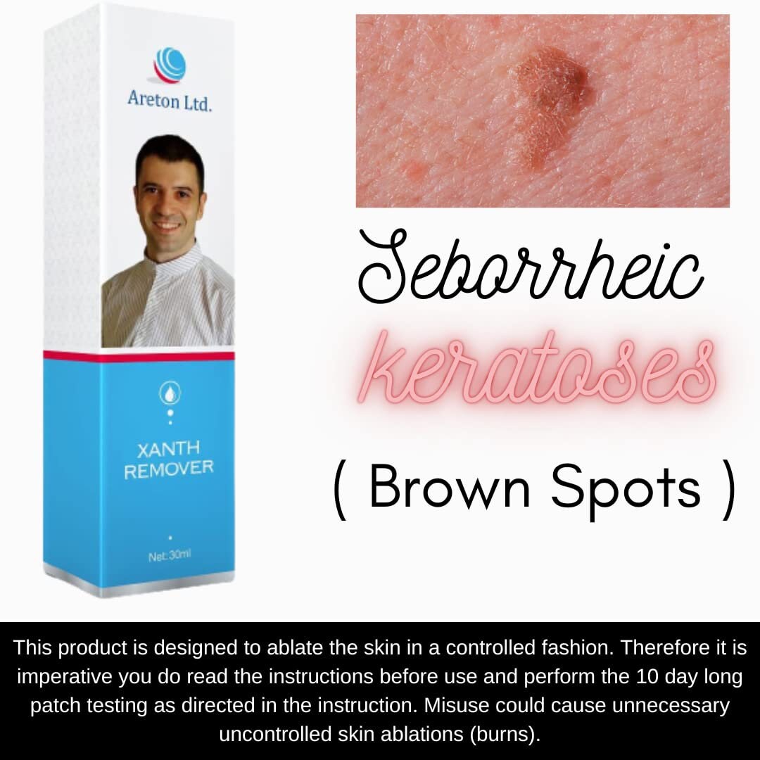 Xanthremover 70 Glycolic Acid Peel, Seborrheic Keratosis, Xanthelasma