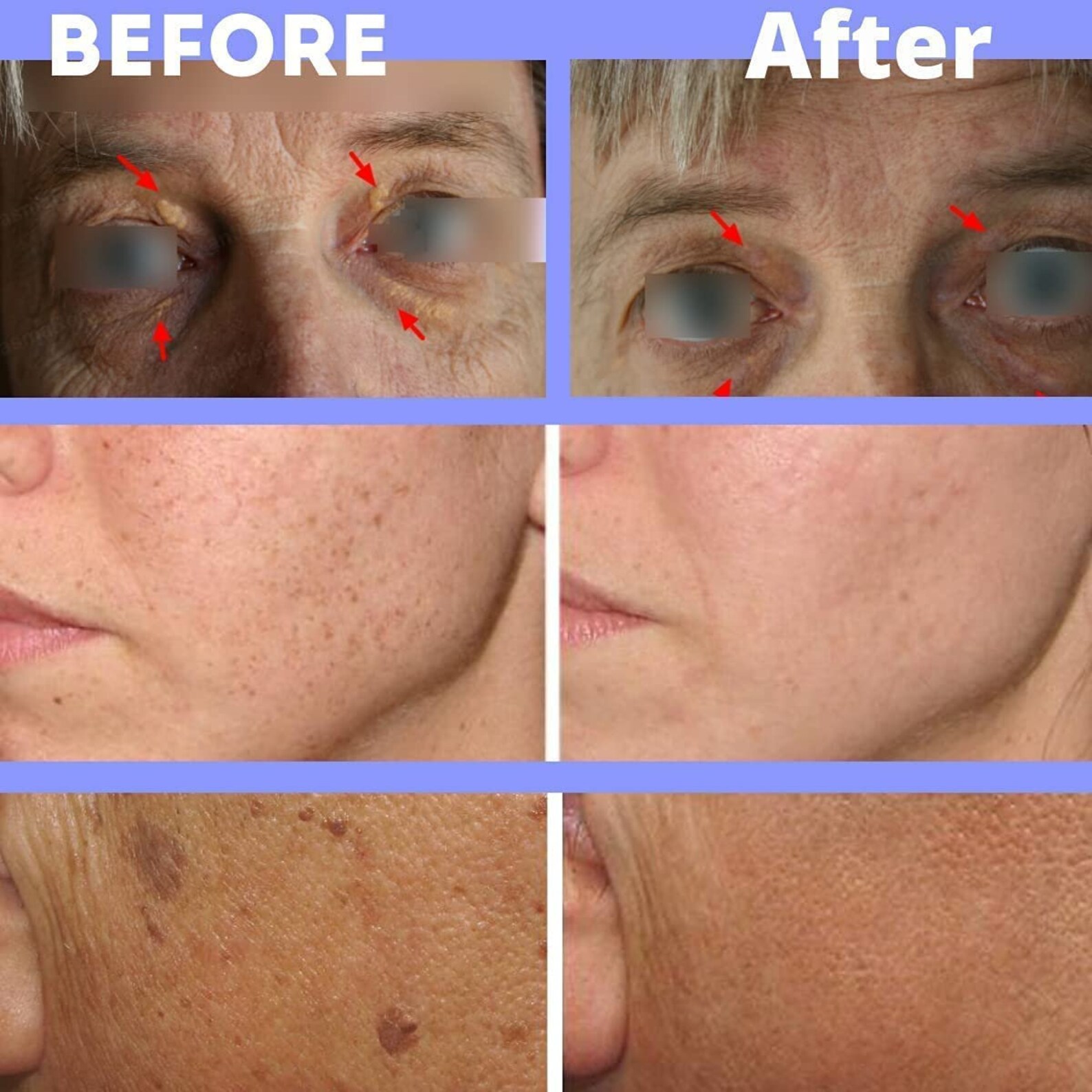 Xanthremover 70 Glycolic Acid Peel, Seborrheic Keratosis, Xanthelasma, Syringoma, Dark Spots