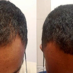 Puede incluir: Fotos de antes y despu&eacute;s que muestran los resultados del crecimiento del cabello despu&eacute;s de 3 meses. La imagen muestra la cabeza de una persona con p&eacute;rdida de cabello en la parte delantera, y luego la misma cabeza con m&aacute;s crecimiento de cabello en la parte delantera.