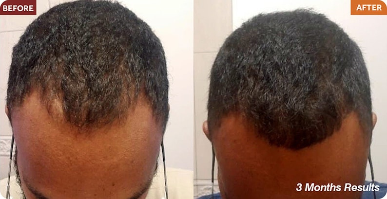 Puede incluir: Fotos de antes y despu&eacute;s que muestran los resultados del crecimiento del cabello despu&eacute;s de 3 meses. La imagen muestra la cabeza de una persona con p&eacute;rdida de cabello en la parte delantera, y luego la misma cabeza con m&aacute;s crecimiento de cabello en la parte delantera.