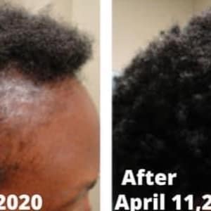Puede incluir: Fotos de antes y despu&eacute;s que muestran el crecimiento del cabello. La foto de antes muestra a una persona con cabello delgado el 10 de marzo de 2020. La foto de despu&eacute;s muestra a la misma persona con cabello m&aacute;s abundante el 11 de abril de 2020.