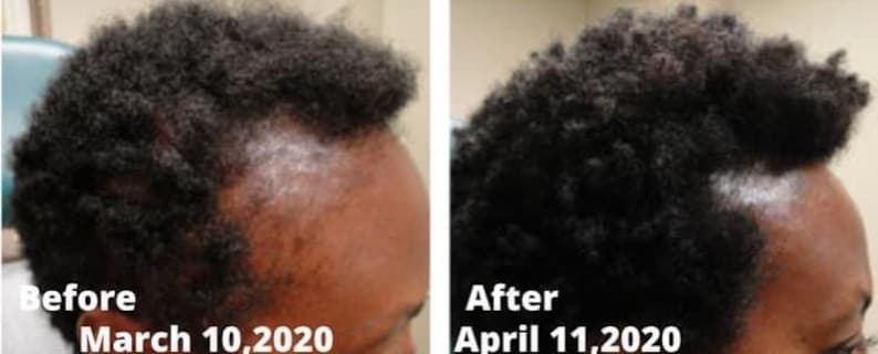 Puede incluir: Fotos de antes y despu&eacute;s que muestran el crecimiento del cabello. La foto de antes muestra a una persona con cabello delgado el 10 de marzo de 2020. La foto de despu&eacute;s muestra a la misma persona con cabello m&aacute;s abundante el 11 de abril de 2020.