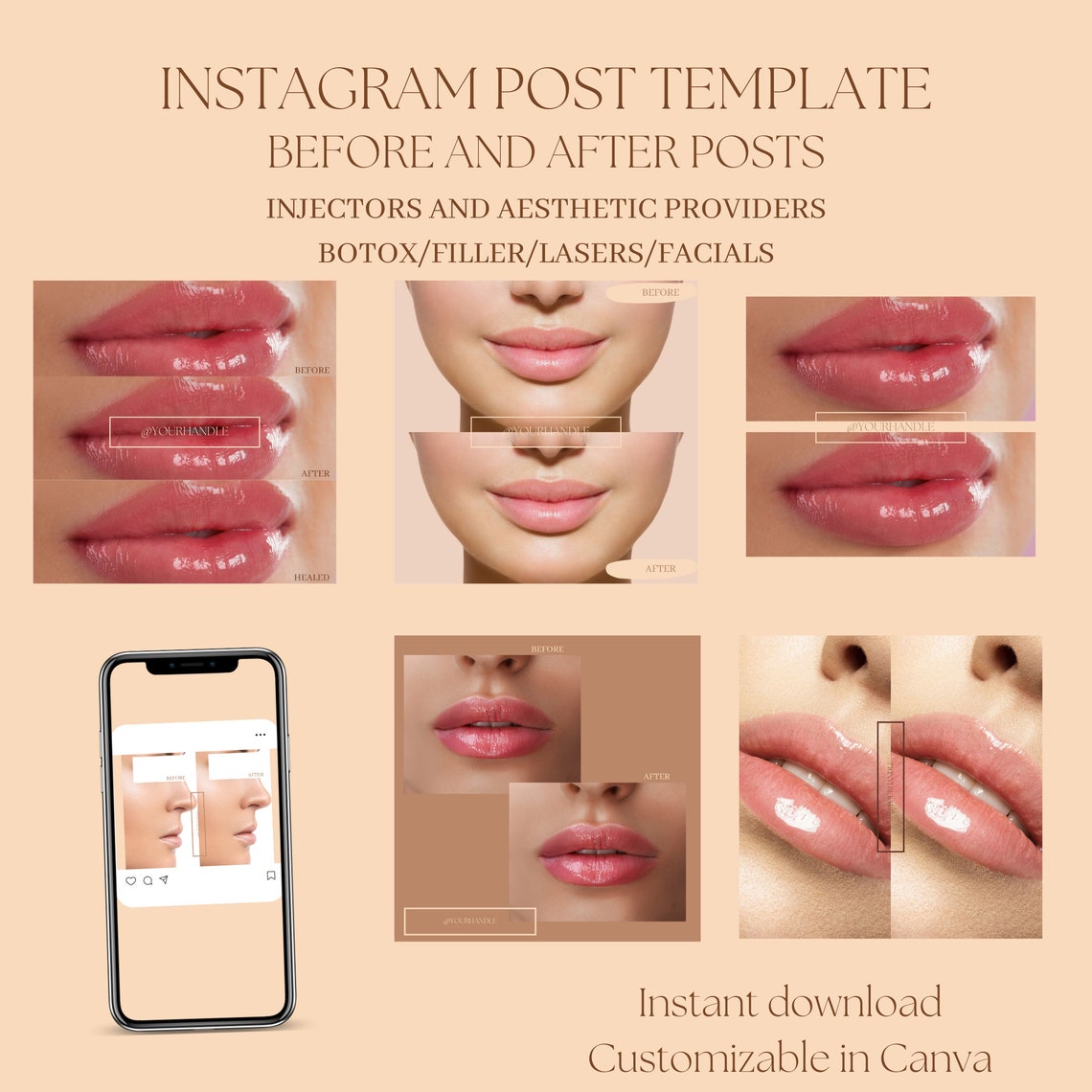 Cosmetic Nurse Injectors, Filler and Botox Neurotoxin Template, Before