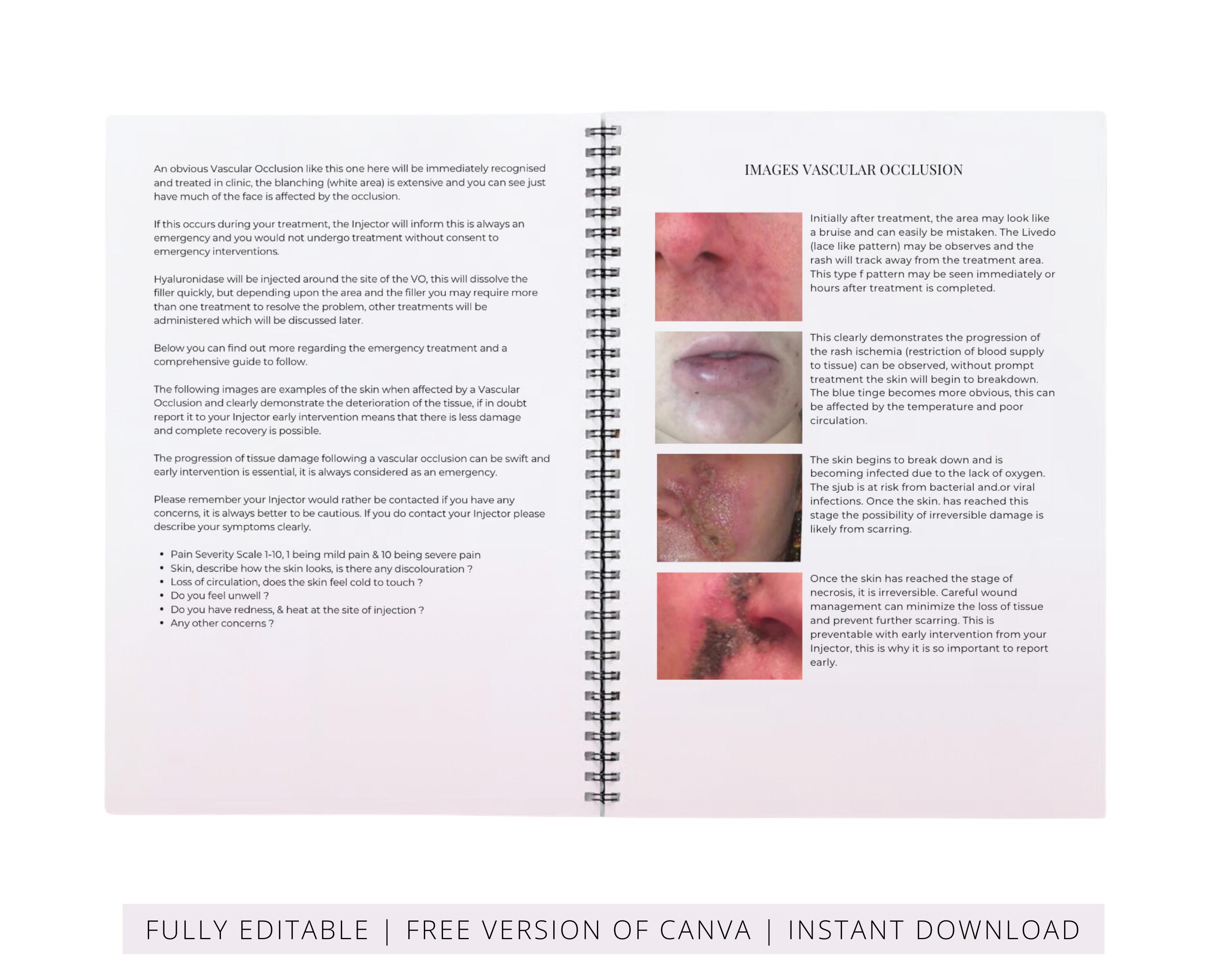 Avonos Patient Guide.pdf Vascular Occlusion Patient Guide, Editable Canva Template - Etsy