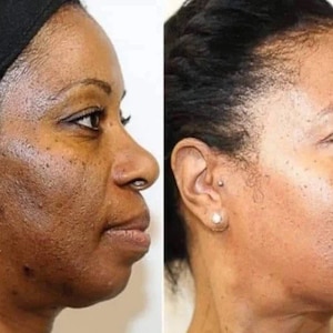 Könnte beinhalten: Ein Vorher-Nachher-Vergleich eines Gesichts. Links ist Haut mit dunklen Flecken und ungleichmäßigem Hautton zu sehen, während rechts ein glatterer, gleichmäßigerer Teint gezeigt wird.