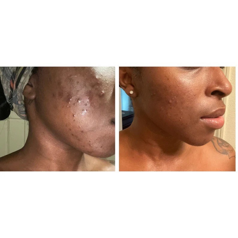 Turmeric & Kojic Brightening Soap, Dark Spots, Dark Inner Thighs, Acne