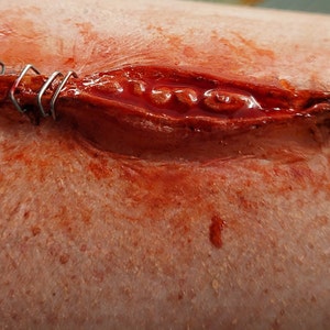 May include: Close-up of a wound on skin with staples. The wound is red and bloody, and the staples are silver.
