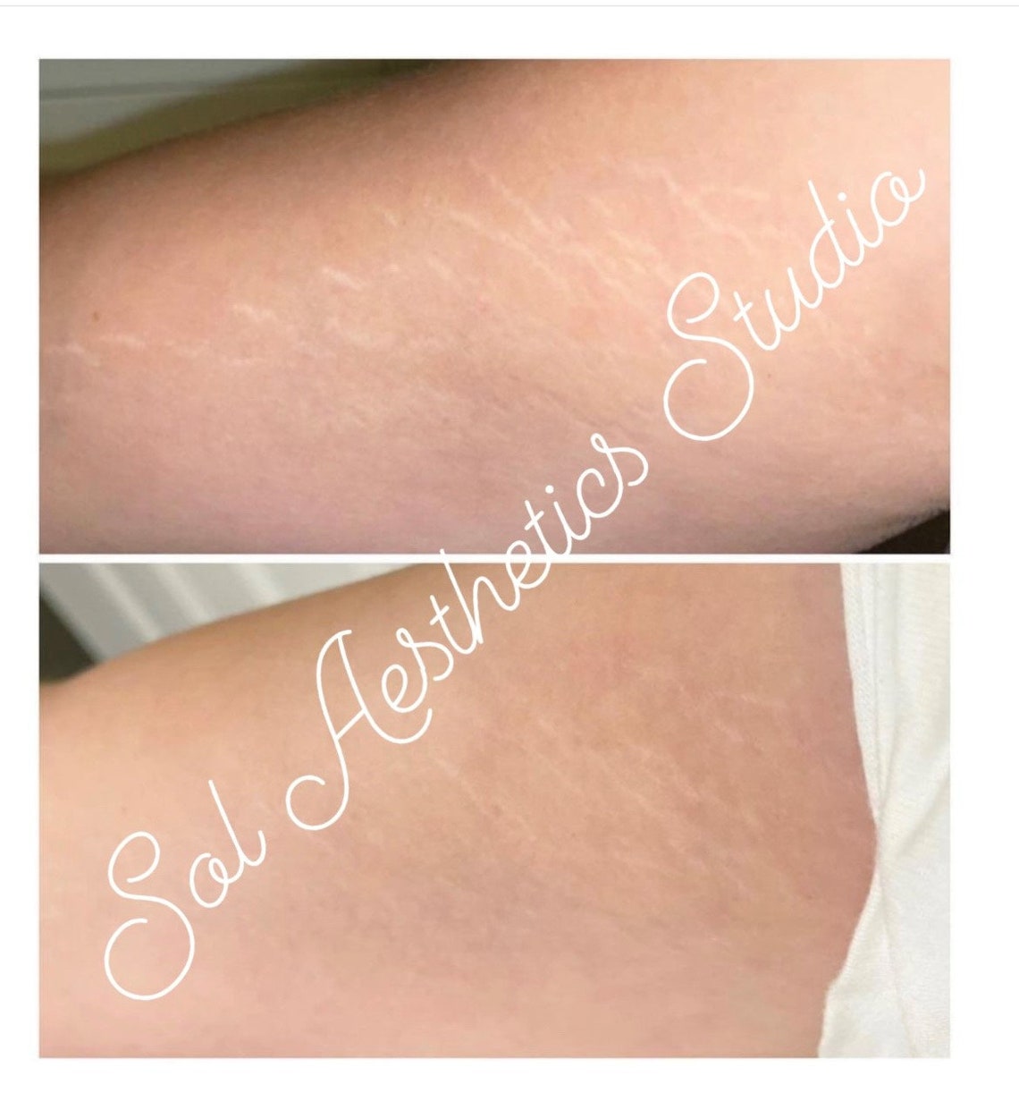 Serum Recipe for Inkless Stretch Mark Technique - Etsy