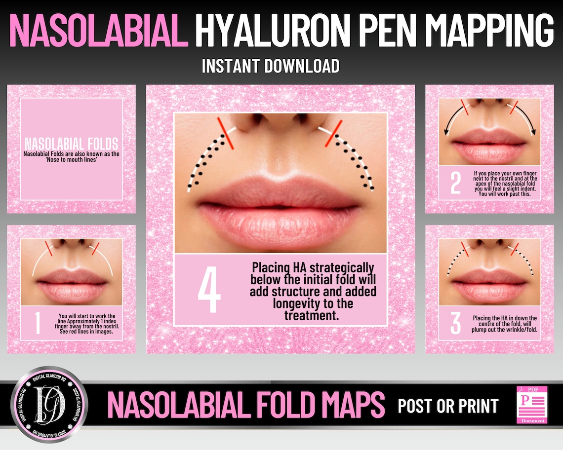 Hyaluron Pen Mapping Techniques for Nasolabial Folds Hyaluron Etsy