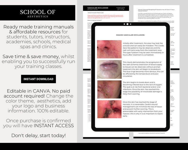 Vascular Occlusion Patient Forms, Vascular Compromise Symptoms