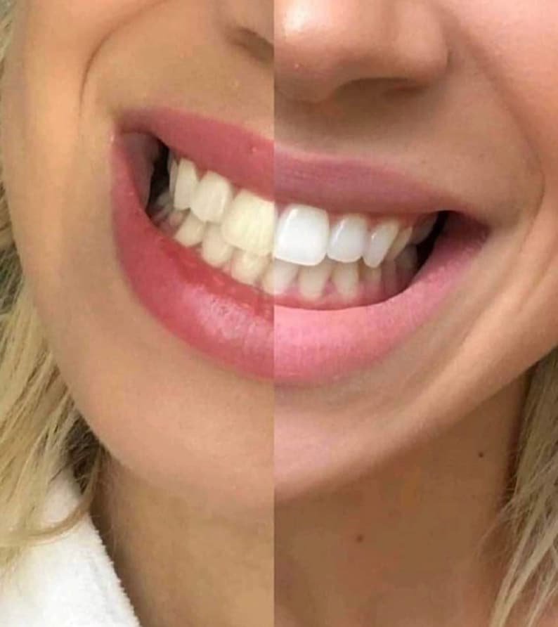 Crest Whitening Strips Etsy