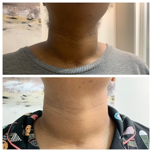 2 weeks of using turmeric bar