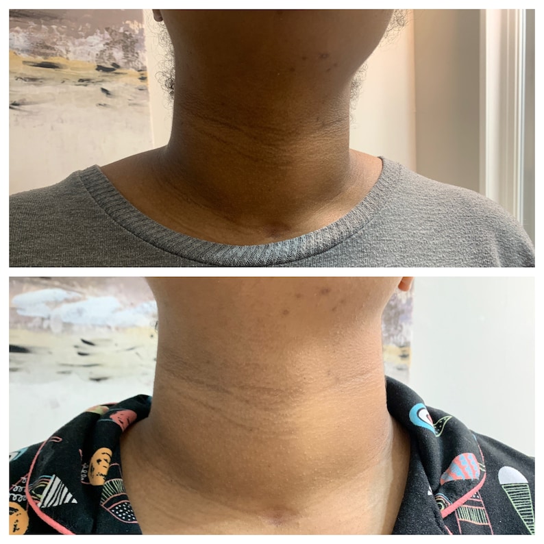 2 weeks of using turmeric bar