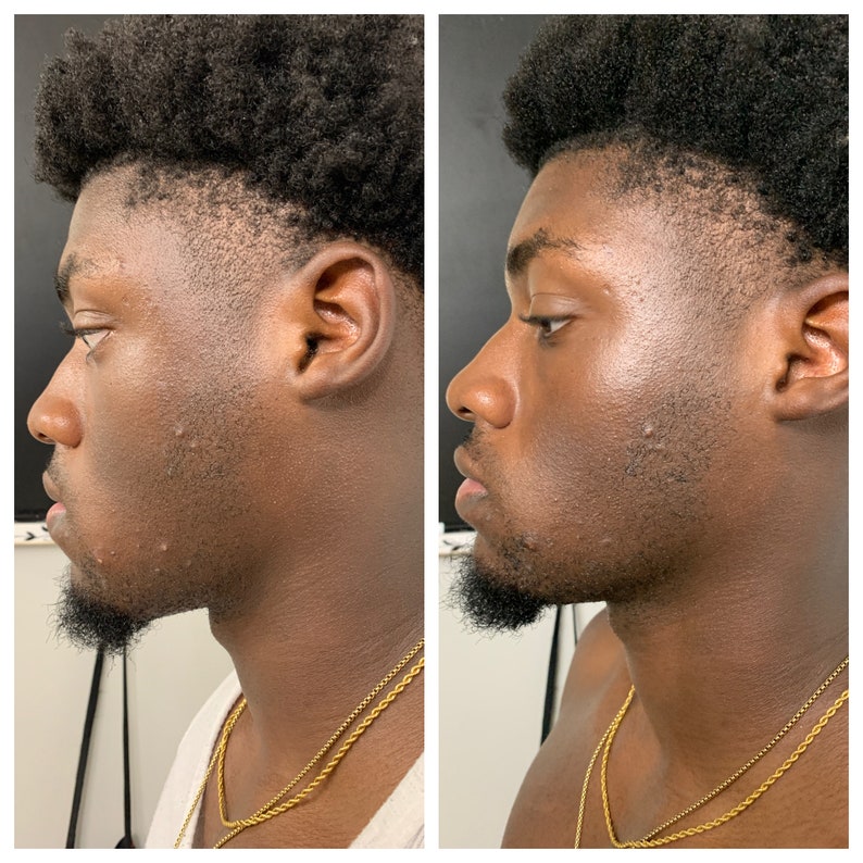 You see the glow? Pimples leaving!!! This was after 1 use!