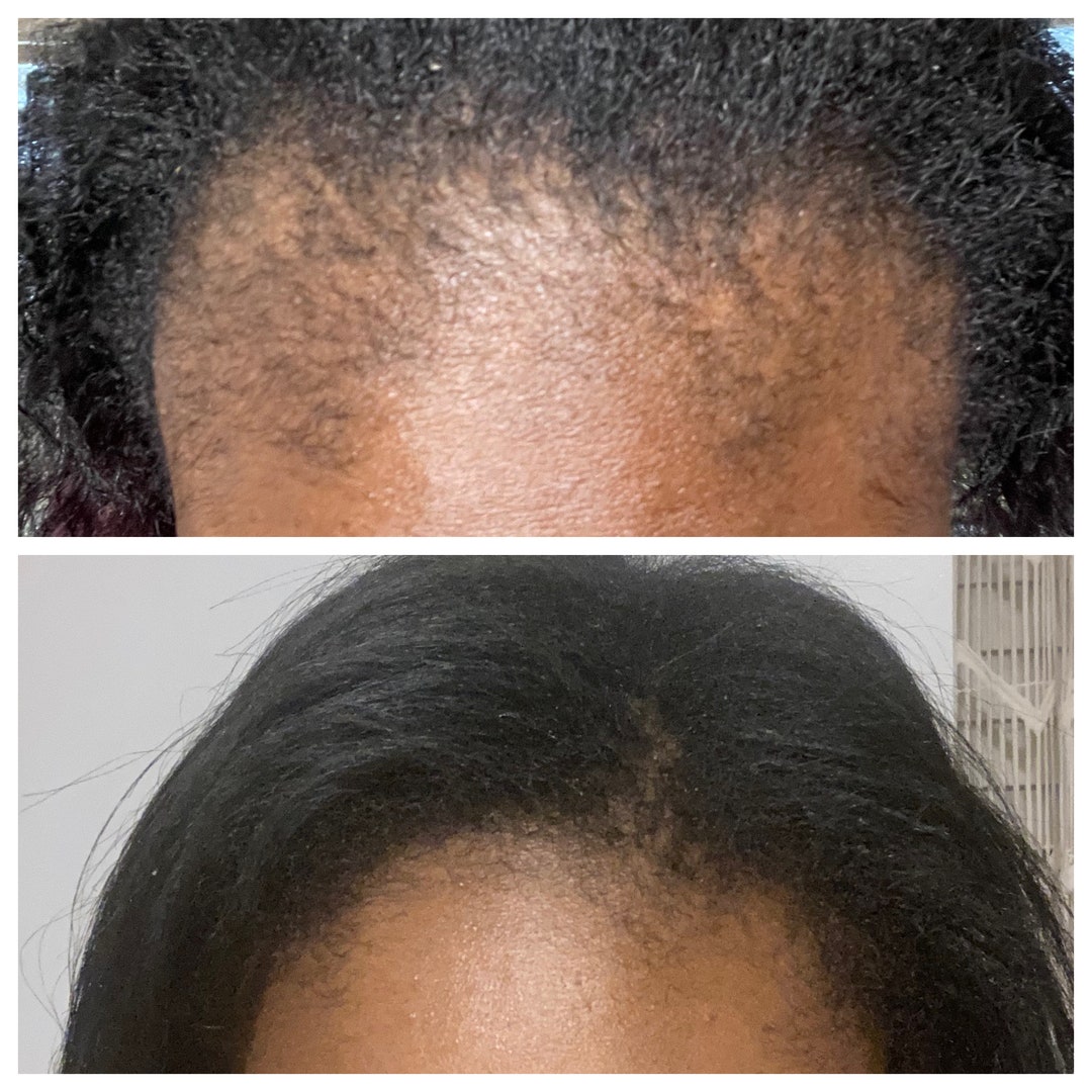 Sarabale Beauty Hair Growth Serum, First Picture is 4 Month Difference ...
