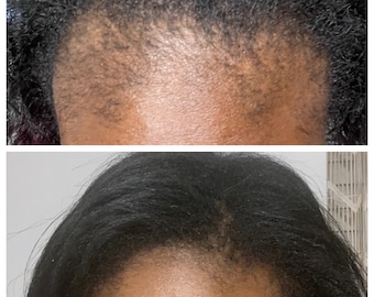 SaraBale Beauty Hair Growth Serum, first picture is 4 month difference