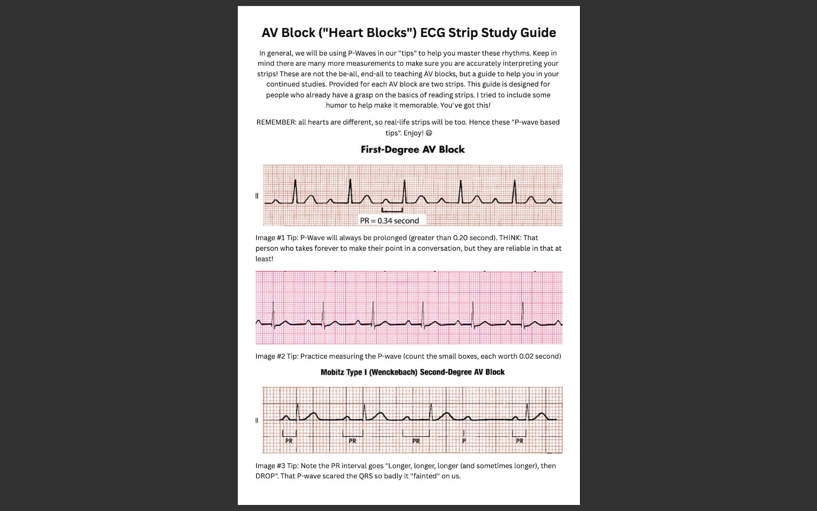ECG/EKG AV Block heart Block Study Guide With Rhythm Strips Etsy