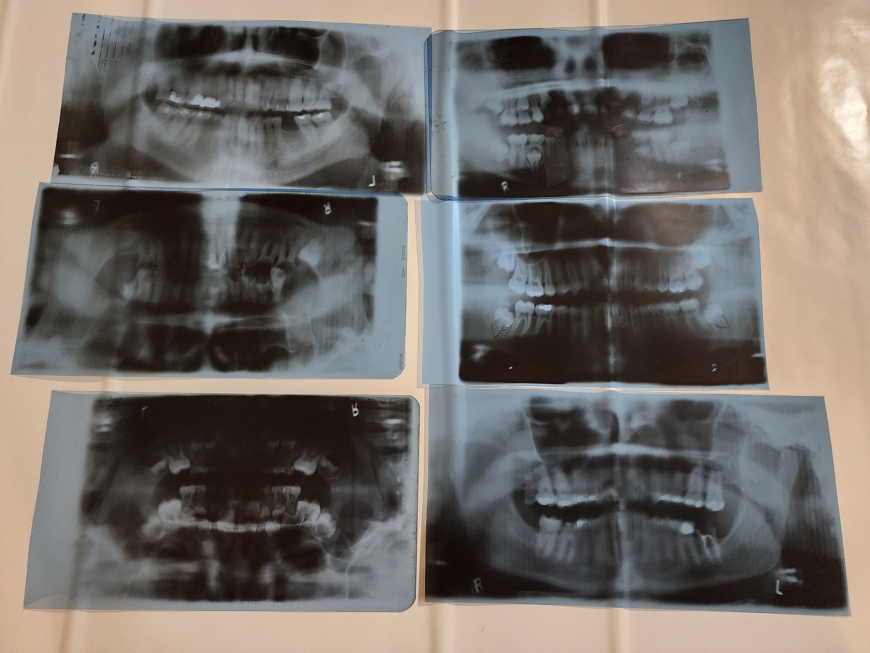 Full Mouth Dental Xrays Etsy