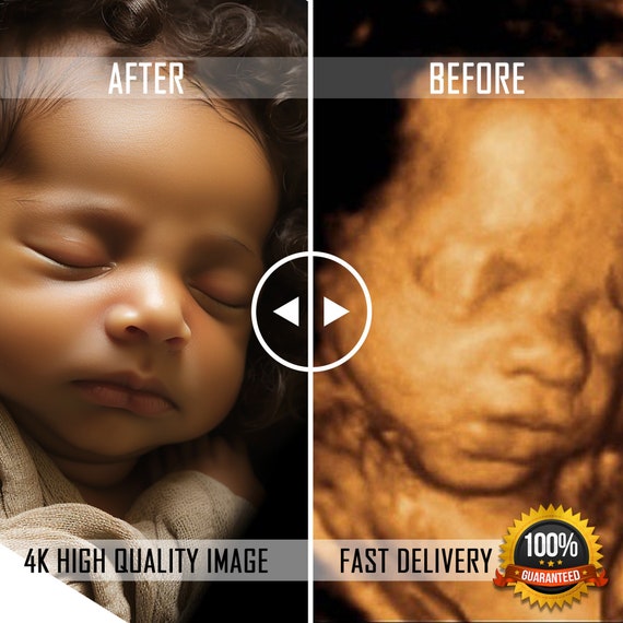 3D 4D 5D and HD Ultrasound. Turn Your Ultrasound Into a