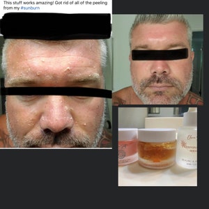 May include: Image shows a man's face with peeling skin, alongside jars of skincare products. Text reads, "This stuff works amazing! Got rid of all of the peeling from my #sunburn."
